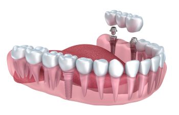 Implants and Bridges